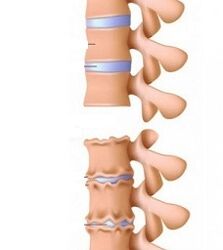 Boyun osteokondroz rampaları aşamaları