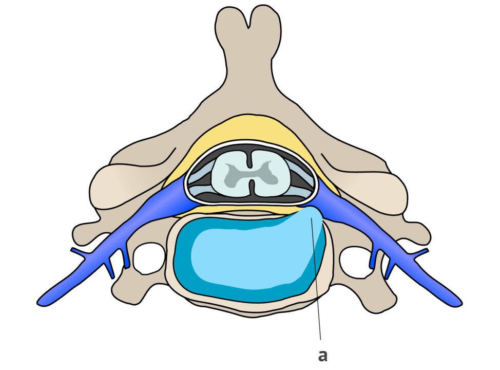 Servikal osteokondrozlu intervertebral fıtık